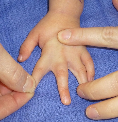 عواملی موجب سین داکتیلی انگشتان دست