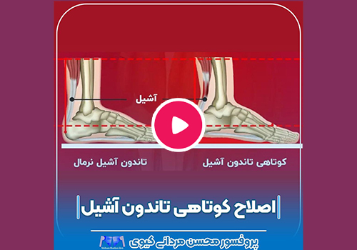 اصلاح کوتاهی تاندون آشیل دو طرفه