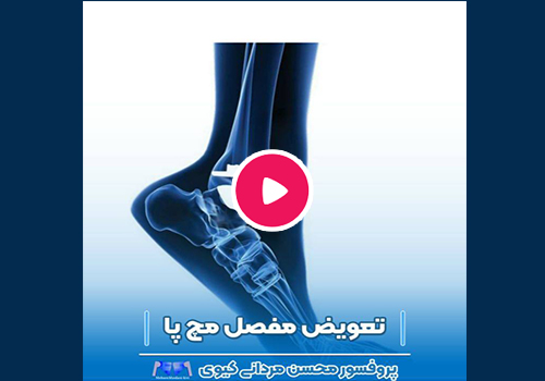 تعويض مفصل مچ پا