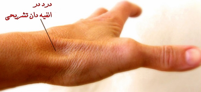 شکستگی هشت استخوان کوچک مچ دست