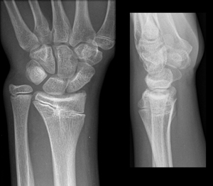 شکستگی صفحه رشد انتهای پایینی استخوان رادیوس در مچ دست 